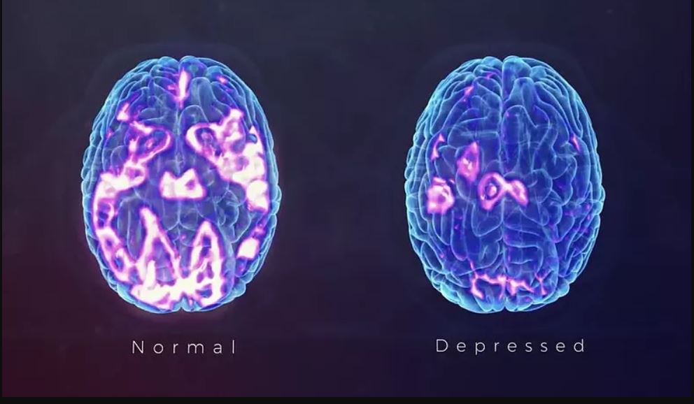 Normal-vs-depressed-brain